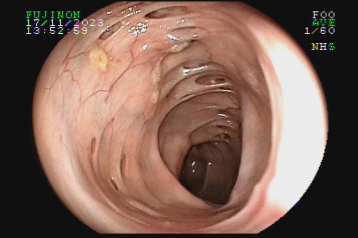 diverticulose