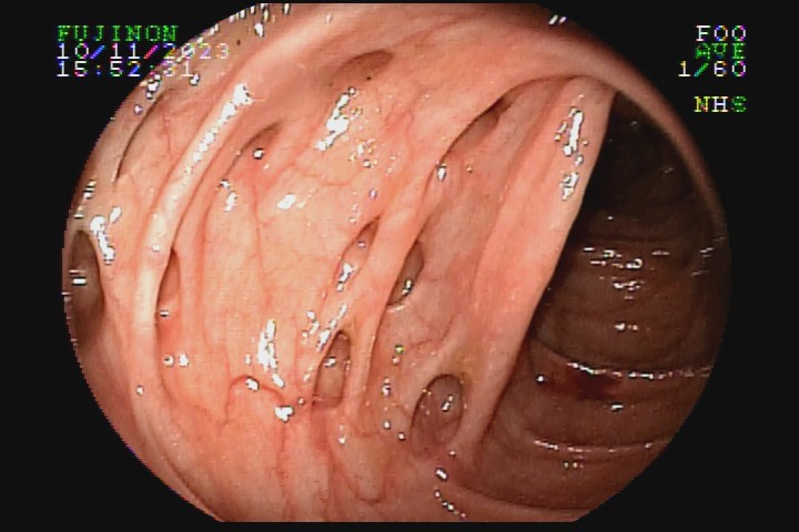 diverticulose