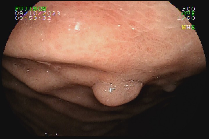 CC polipo glandular.jpg