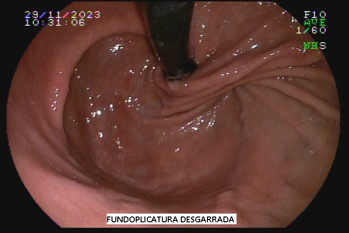 fundoplicatura