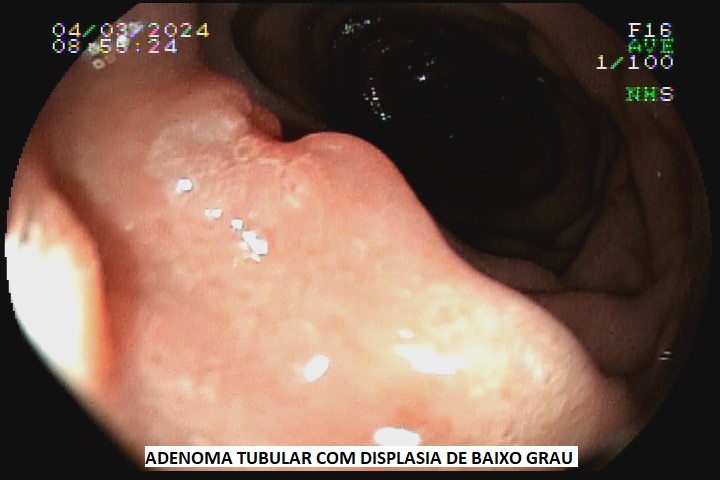 adenoma