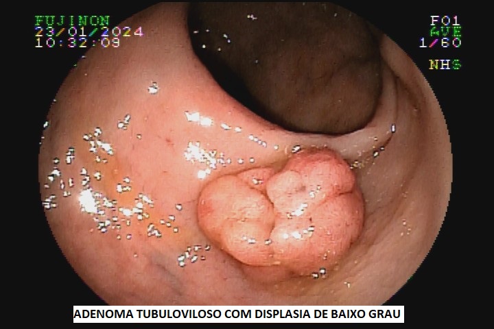 adenoma