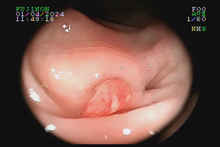 diverticulose