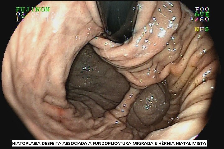 fundoplicatura