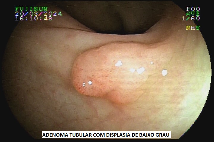 adenoma