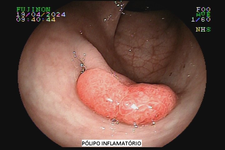 polipo inflamatorio adriana.jpg