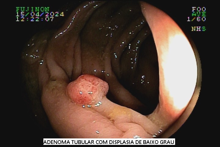 adenoma