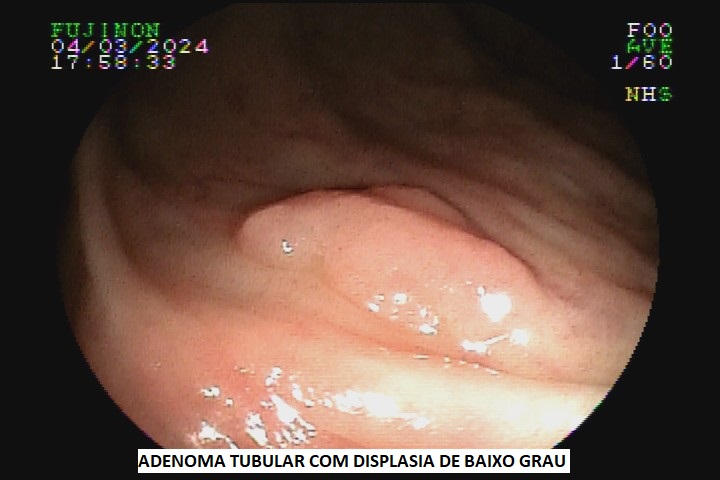 adenoma