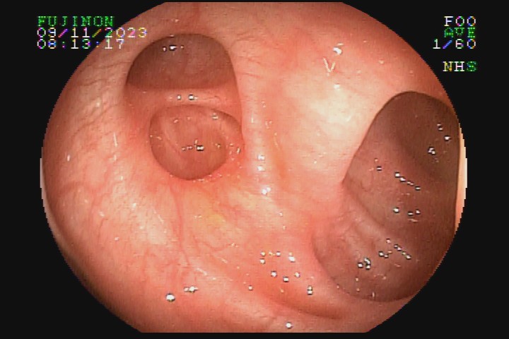 diverticulose