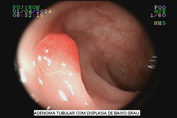 adenoma