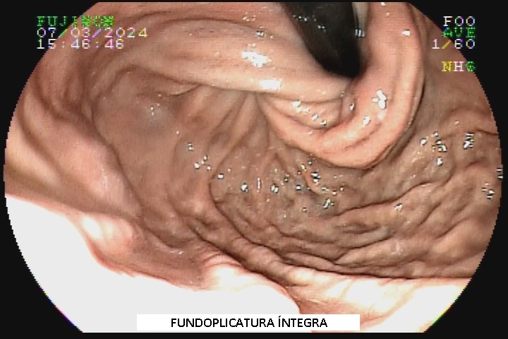 fundoplicatura