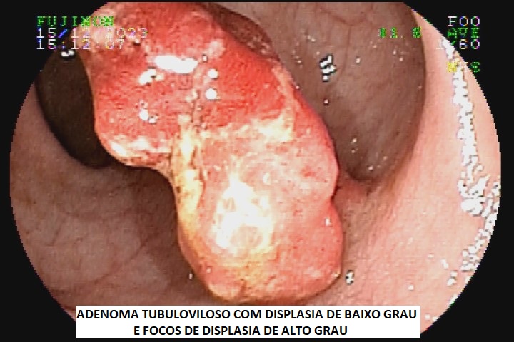 adenoma