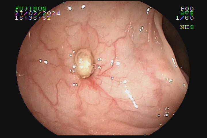 diverticulose