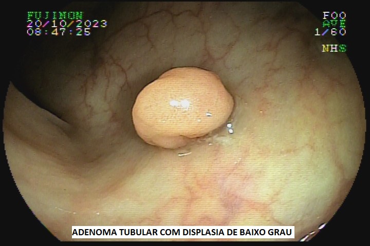 adenoma