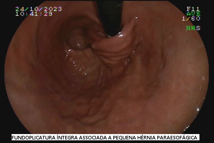 fundoplicatura