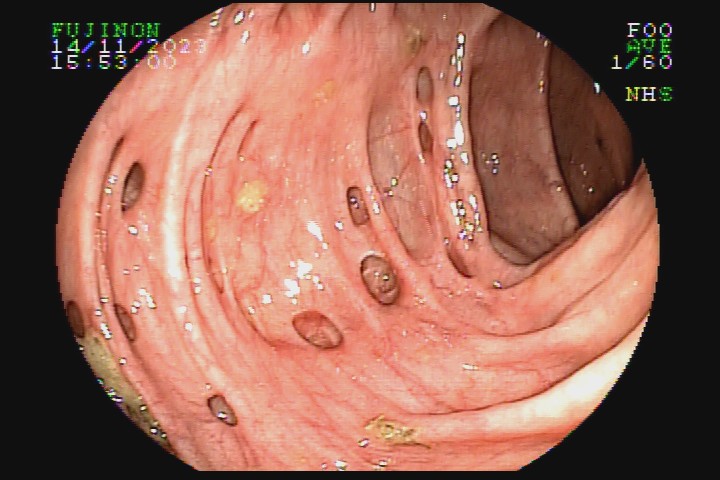 diverticulose