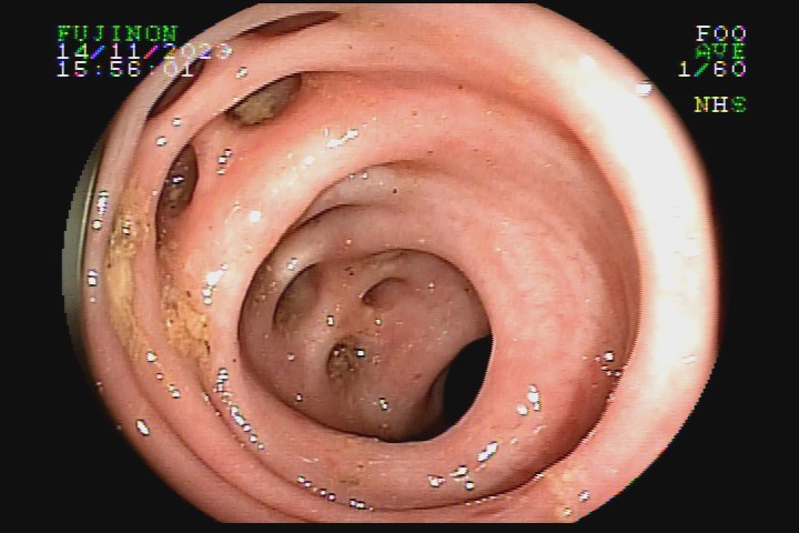 diverticulose