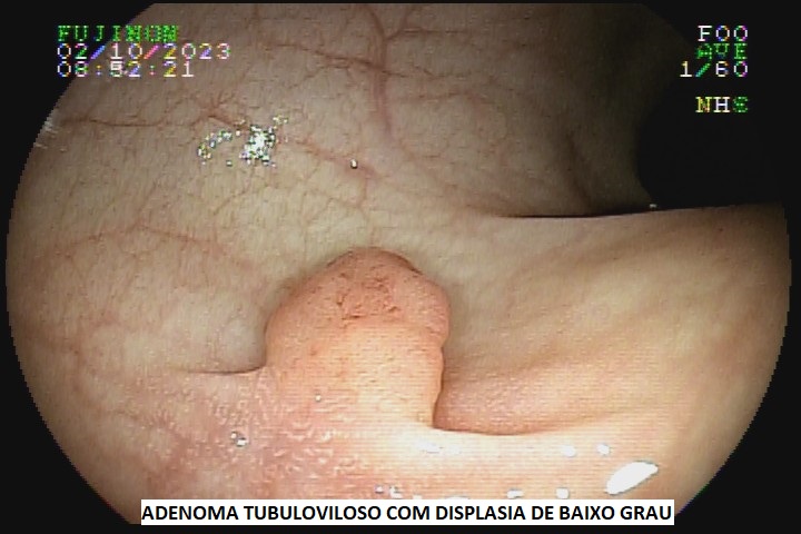adenoma