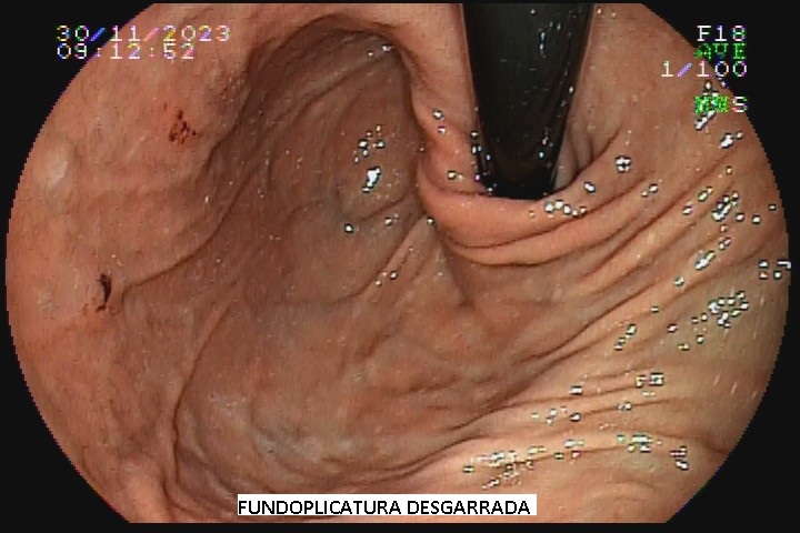 fundoplicatura